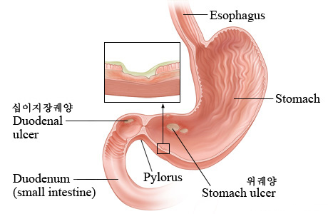 십이지장암 십이지장궤양 증상 용종부터 이어지는 원인, 진단방법과 치료정보까지 4