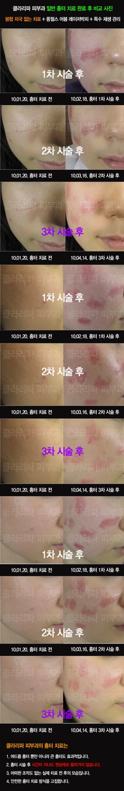 클라리소닉 여드름 흉터 전후