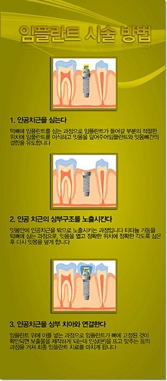 [석플란트 치과병원/암풀란트/임플란트치과/강남 임플란트/임플란트 가격/임플란트 전문]