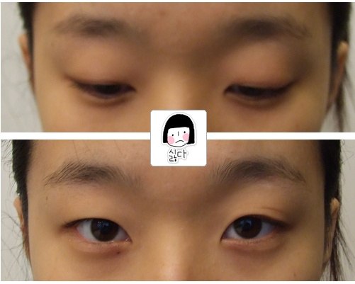  [눈매교정술] 눈매교정술 후기 [애플성형외과/신근식원장]