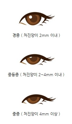  [눈매교정술] 안검하수를위한 - 눈매교정술 [애플성형외과/신근식원장]