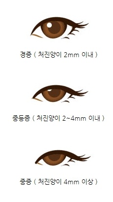 [눈매교정술] 눈매교정술? 눈매교정술이 뭔가요? [애플성형외과/신근식원장]