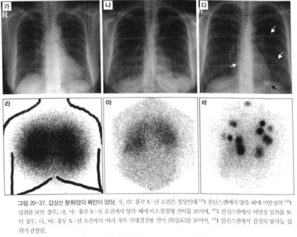 갑상선암 전이의 원인, 증상, 치료 및 주의사항