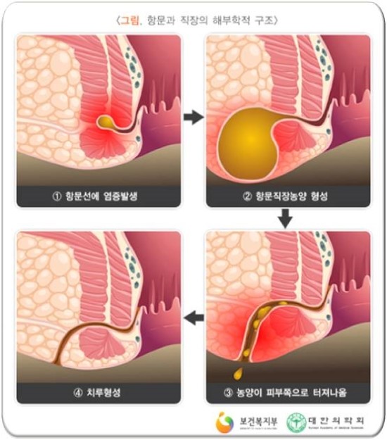 항문 주위 농양을 열어 둘 수 있습니까?
