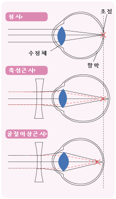 [건강칼럼]정시, 근시, 원시, 난시란? 6