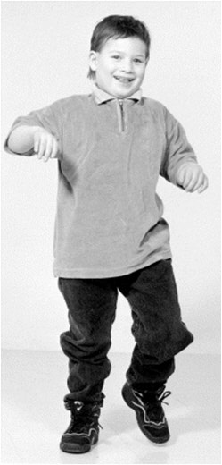 엔젤만 증후군을 앓고 있는 성인