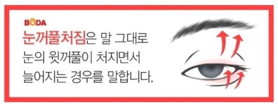 [대전안과 대전눈꺼풀처짐 대전안검하수] 자꾸 처지는 눈꺼풀! 눈이 활짝 떠지지가 않아요...