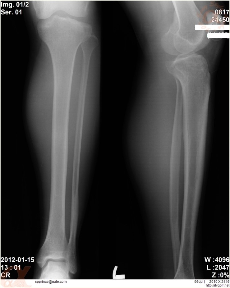  이번 스키장에서 사고후 무릎수술 전 후 사진들..(X-Ray, CT, MRI)