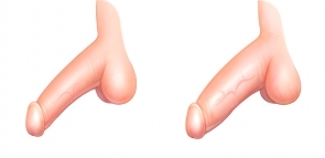  실리콘링 있는 상태에서 알로덤 복합 성기확대술 