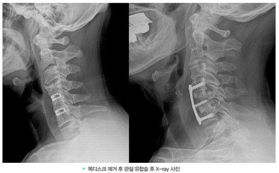 목디스크 수술 잘하는곳 보존적 치료 호전 없으면