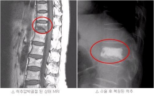 손실없는 척추 압박 골절 상해 보상 계약 4