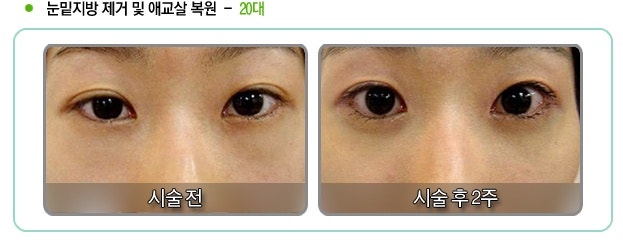 [김성완피부과] 눈밑지방재수술 안하는방법,눈밑지방재발안하는방법