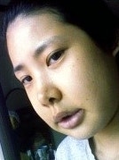 돌출입수술 비용
