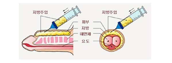  [ 성기수술 ] @@ 미세자가지방 성기확대수술 @@