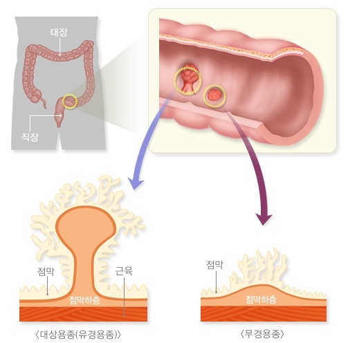 선종성 용종의 원인과 검사 방법을 익히다 2