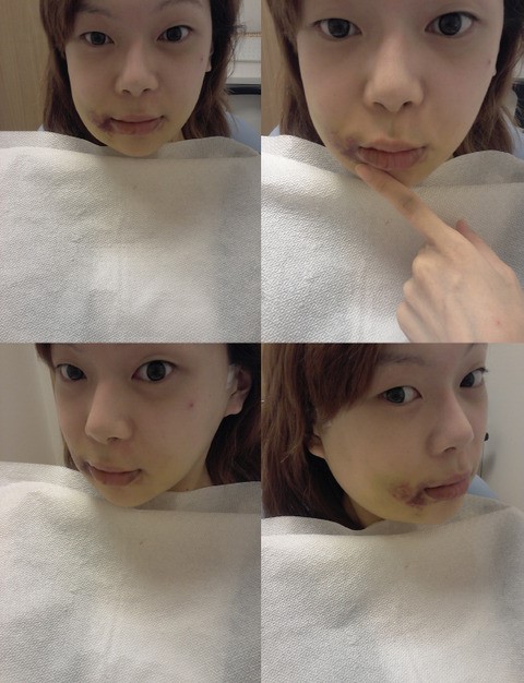 광대수술 후기 1년 : 네이버 블로그 광대수술 후기 1년 : 네이버 블로그