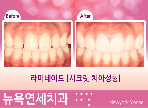  라미네이트_[시크릿치아성형] 앞니 가지런하게 만들기