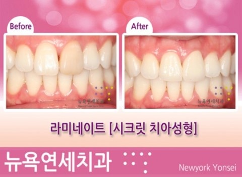  [라미네이트] 시크릿 치아성형 전문 (치아성형잘하는곳, 라미네이트잘하는곳)