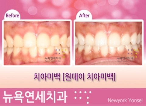  치아미백*치아미백잘하는곳 시술전후