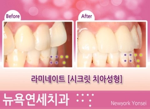  치아성형 & 잇몸성형 _ 변신동안만들기 [시크릿 치아성형-라미네이트]