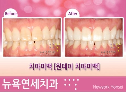  치아색소침착*치아미백 시술전후