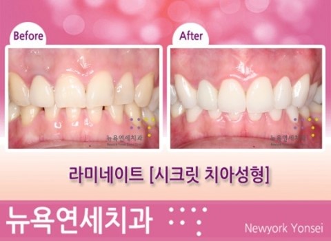  [치아성형] 라미네이트 시술전후