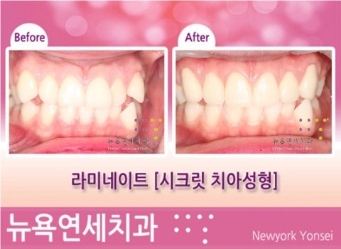  덧니치아성형*덧니라미네이트 시술전후