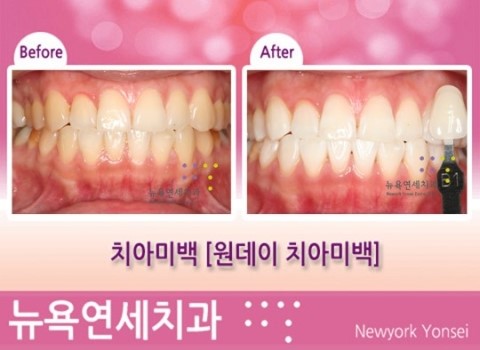  [원데이치아미백] 치아미백 시술전후