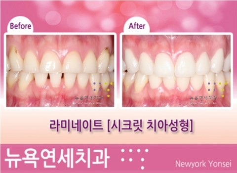 [라미네이트] 치아성형 시술전후