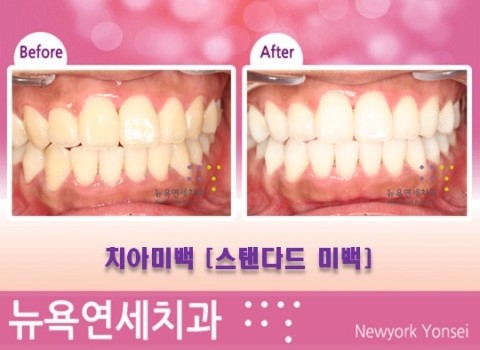  원데이치아미백*치아미백