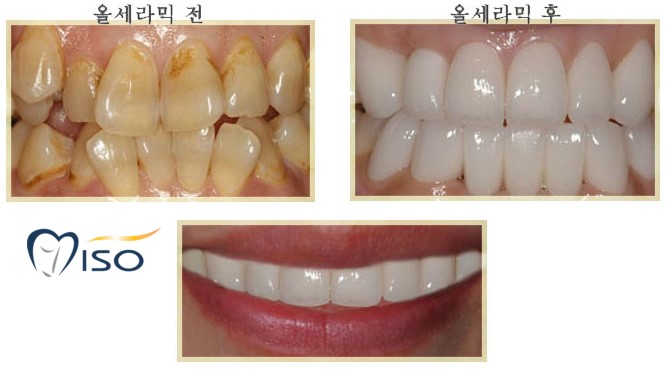 Gaoyang 치과 용 라미네이트와 올 세라믹의 차이점 8