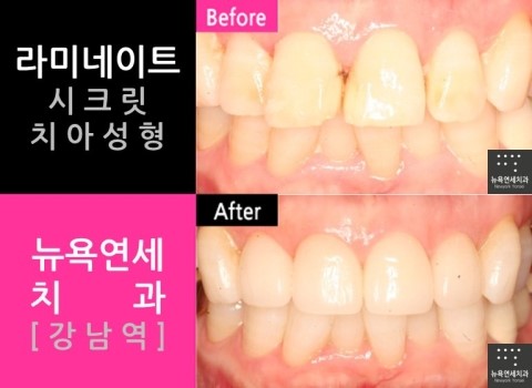  라미네이트잘하는곳