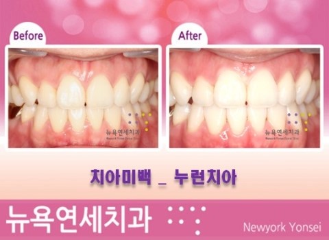  치아미백 시술전후