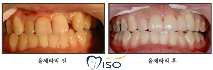 Gaoyang 치과 용 라미네이트와 올 세라믹의 차이점 9
