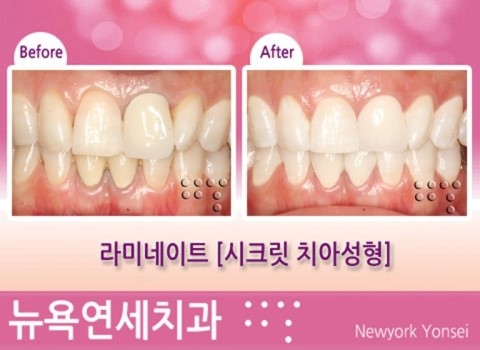  라미네이트*시크릿치아성형 시술전후