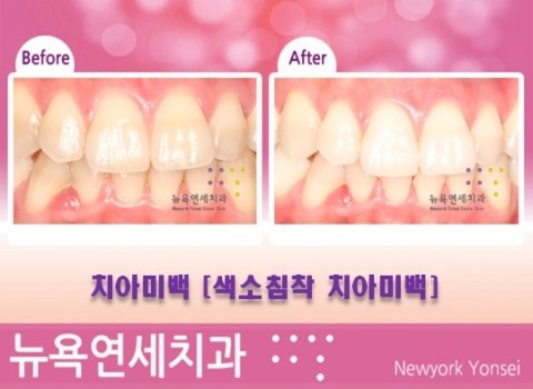  [치아미백] 원데이치아미백*줌치아미백