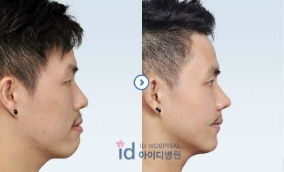 돌출입수술 비용 어떻게 될까?
