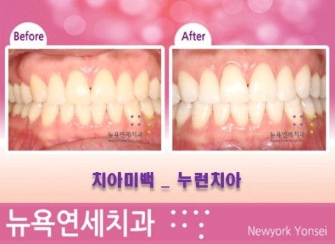  치아미백 가격 & 비용
