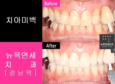 치아미백 전후사진