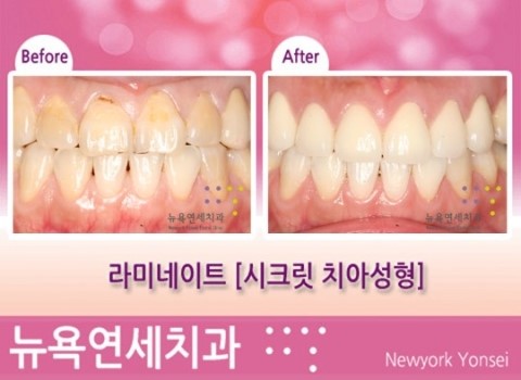  앞니치아성형, 치아성형잘하는곳