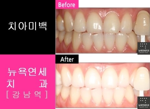  앞니치아미백, 치아미백잘하는곳