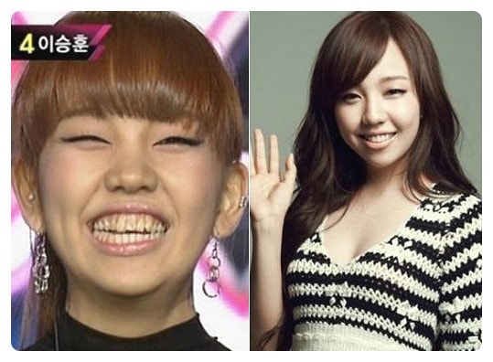 k팝스타 백아연-너무 이뻐진 백아연치아..라미네이트만?성형까지?