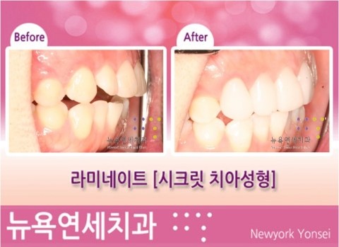  [강남역치과 치아성형] 잘하는곳