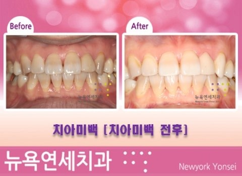 [강남역 치아미백치과] 치아미백 시술전후