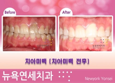  강남역치과 치아미백 전문