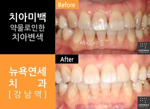 [치아미백]치아미백잘하는곳＆치아미백비용