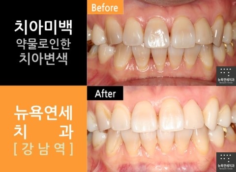  [치아미백]치아미백잘하는곳＆치아미백비용
