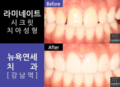  [강남역치과 라미네이트] 전문