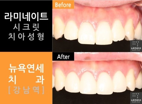  [라미네이트잘하는곳] 앞니 라미네이트 전문치과