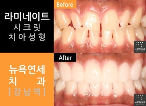  [강남역치과] 라미네이트 잘하는곳